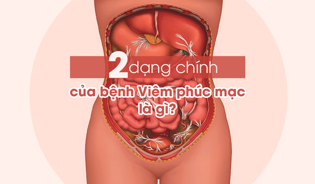 Hai dạng chính của bệnh Viêm phúc mạc là gì?