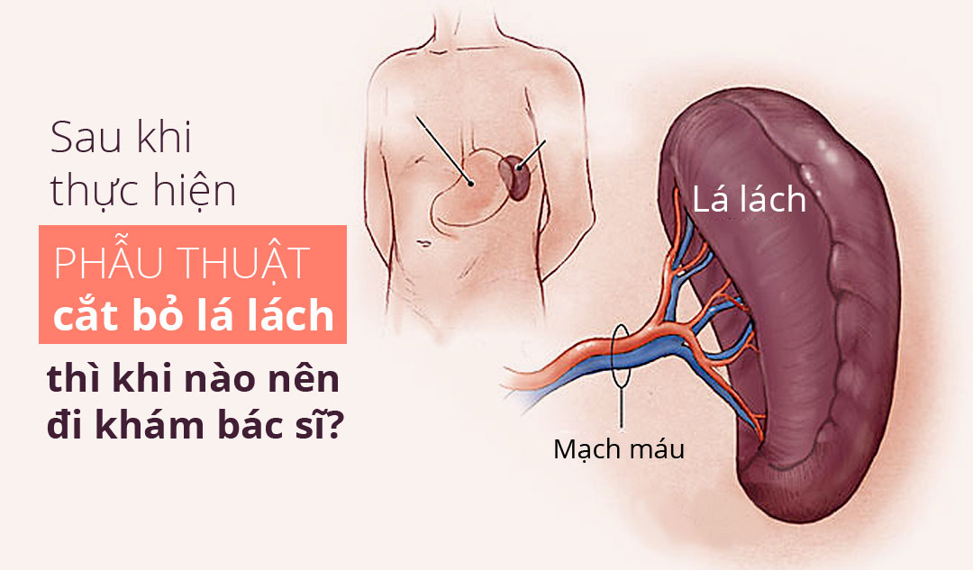 Sau khi thực hiện phẫu thuật cắt bỏ lá lách thì khi nào nên đi khám bác sĩ?