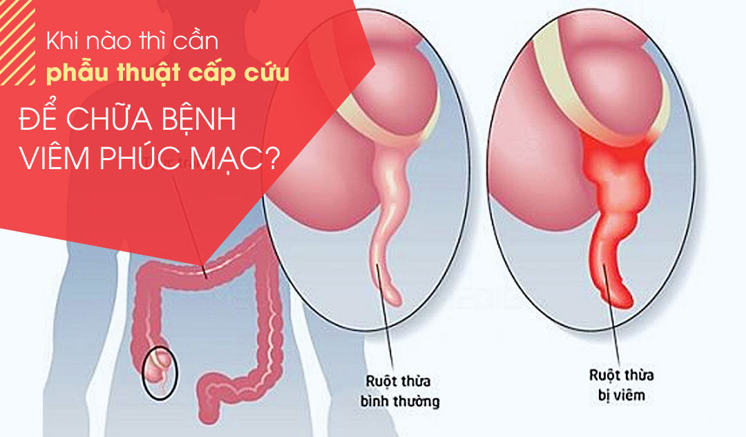 Khi nào thì cần phẫu thuật cấp cứu để chữa bệnh Viêm phúc mạc?