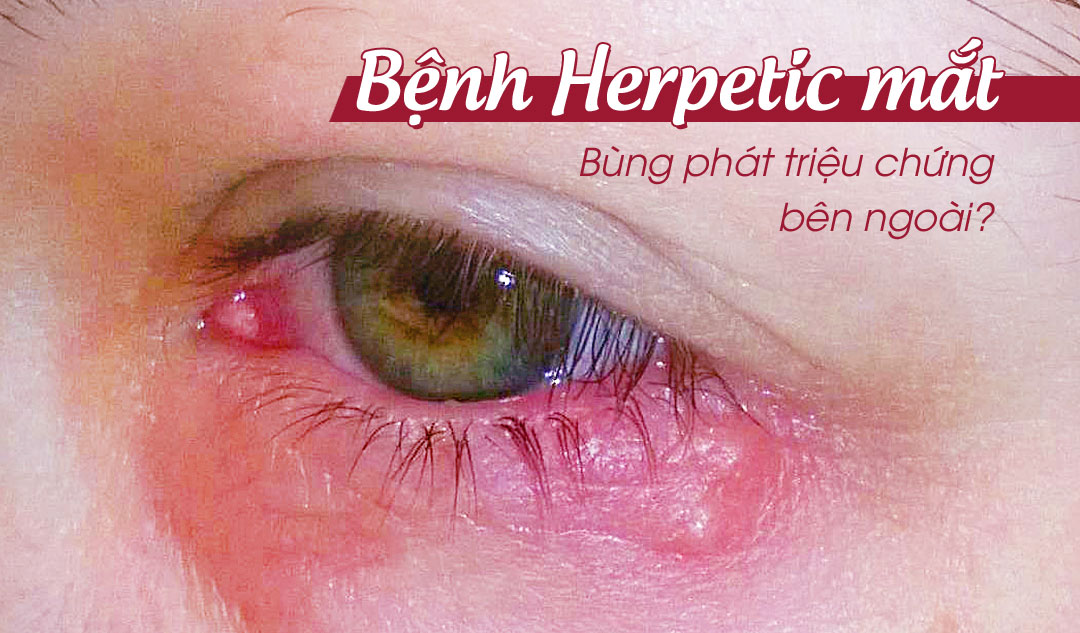 Làm thế nào để bệnh Herpetic mắt bùng phát triệu chứng bên ngoài?