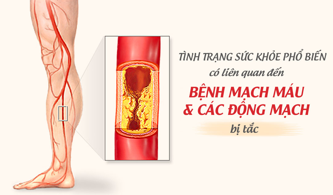 Những tình trạng sức khỏe phổ biến có liên quan đến bệnh mạch máu và các động mạch bị tắc?