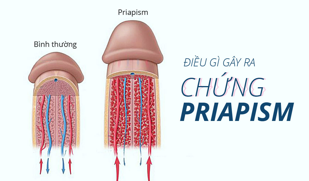 Điều gì gây ra chứng priapism?