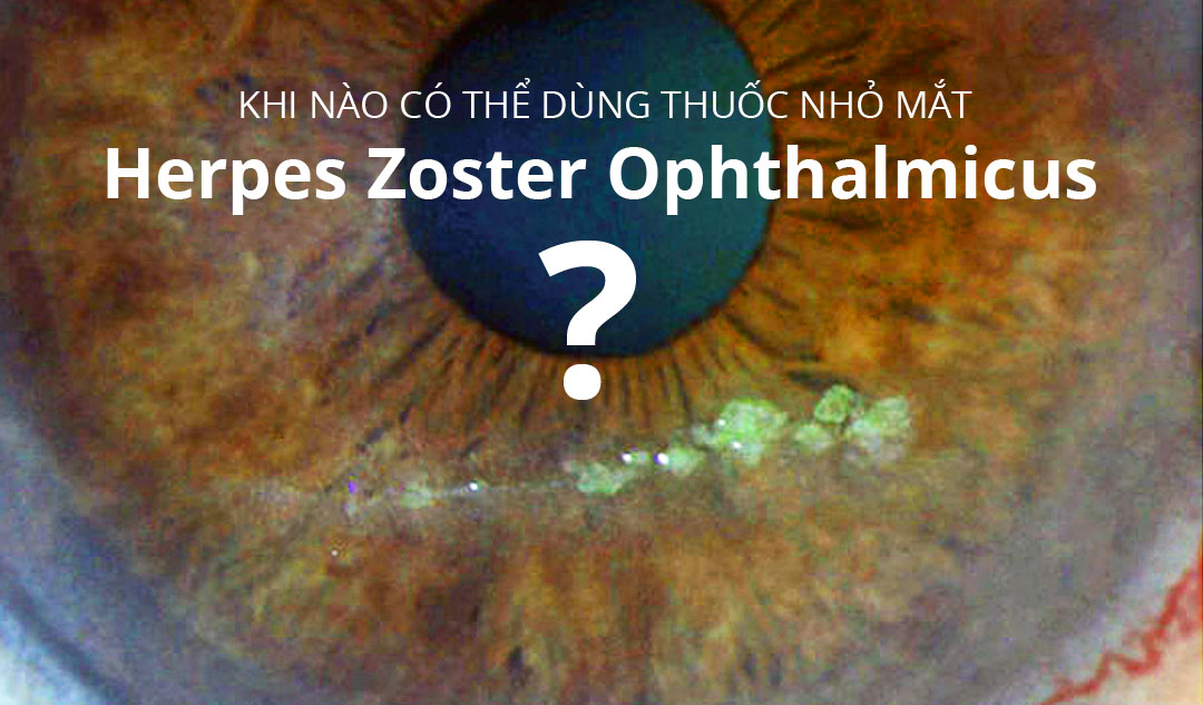 Khi nào có thể dùng thuốc nhỏ mắt cho herpes zoster ophthalmicus?