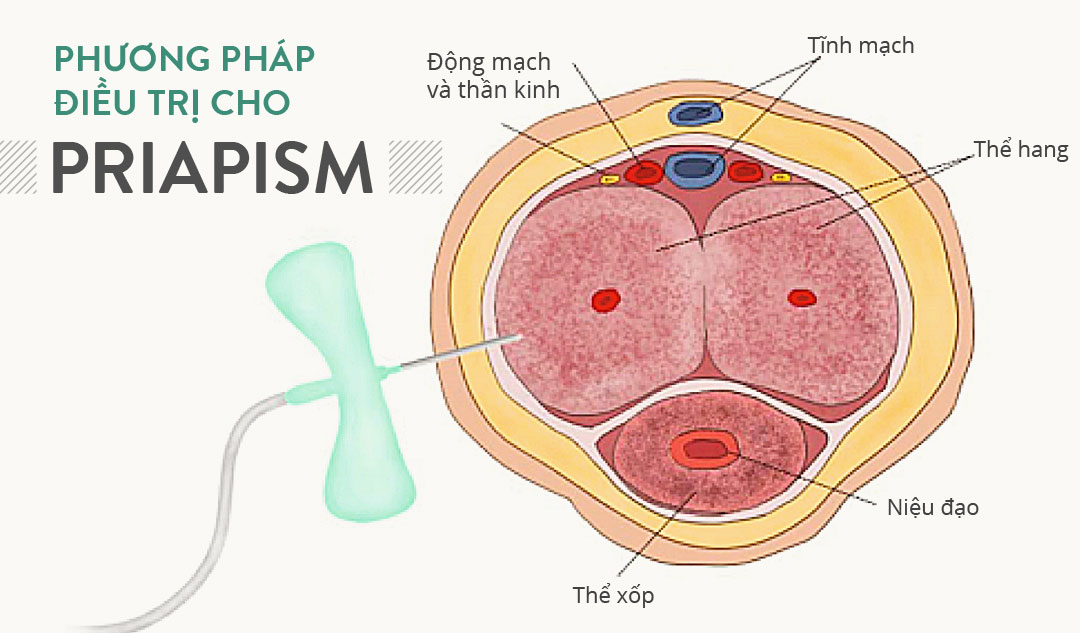 Phương pháp điều trị cho priapism là gì?