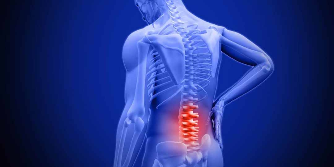 Căng cơ thắt lưng là bệnh gì và hướng điều trị căn bệnh này như thế nào?