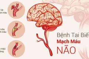 Bệnh Tai Biến Mạch Máu Não