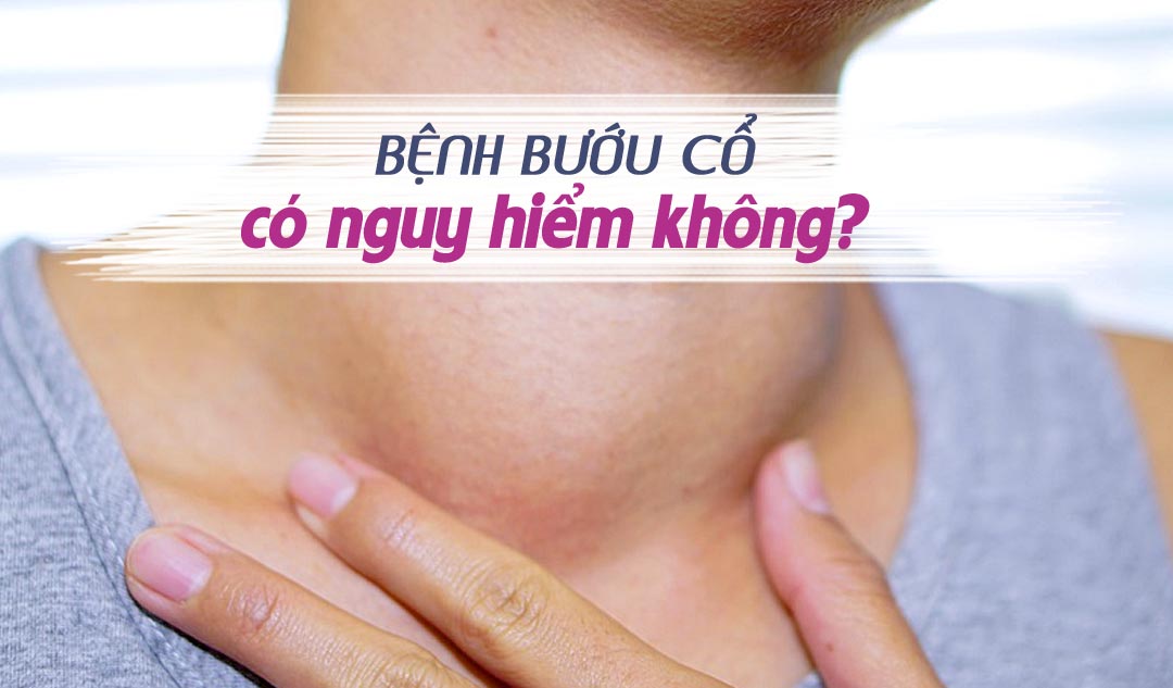 Bệnh bướu cổ có nguy hiểm không?