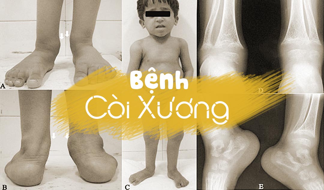 Bệnh Còi Xương