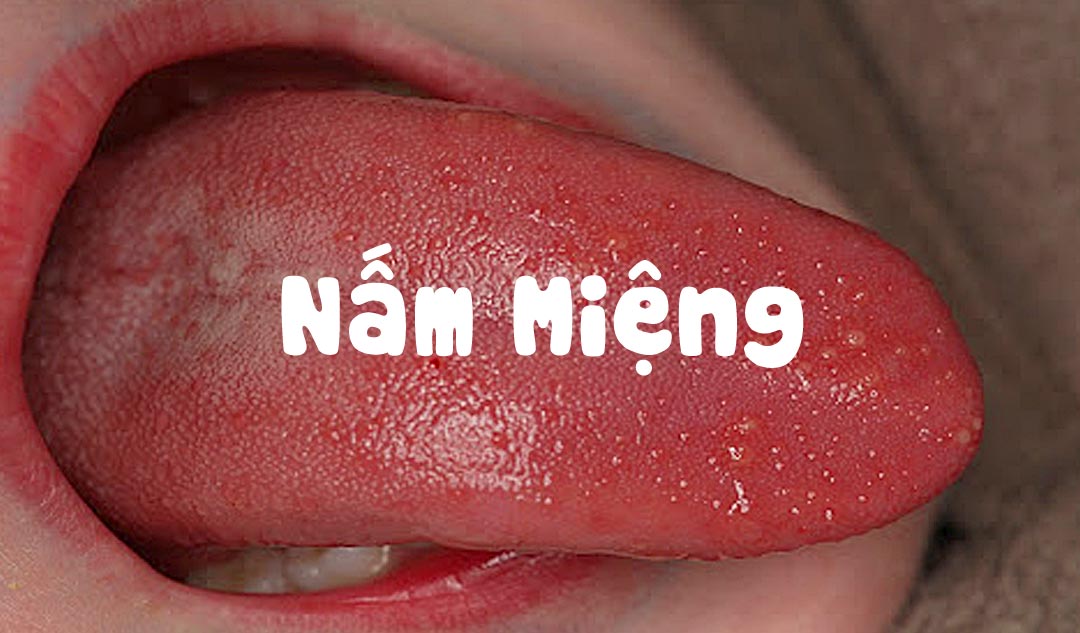 Bệnh Nấm Miệng