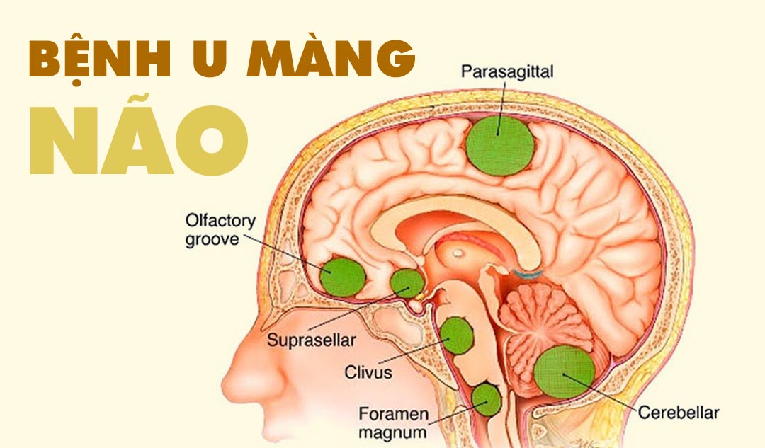 Bệnh U Màng Não