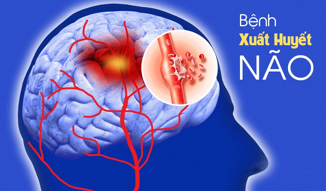 Bệnh Xuất Huyết Não