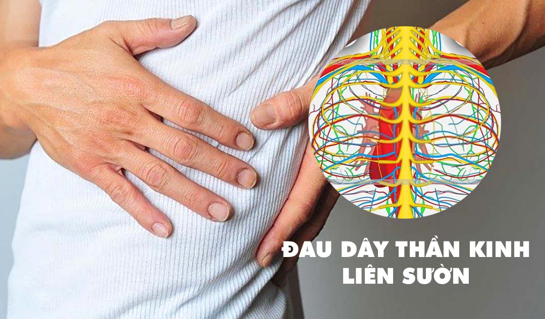 Bệnh Đau Dây Thần Kinh Liên Sườn