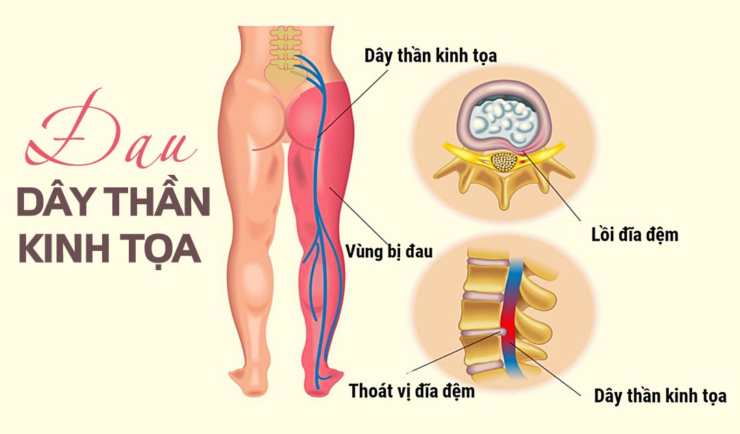 Bệnh Đau Dây Thần Kinh Tọa 