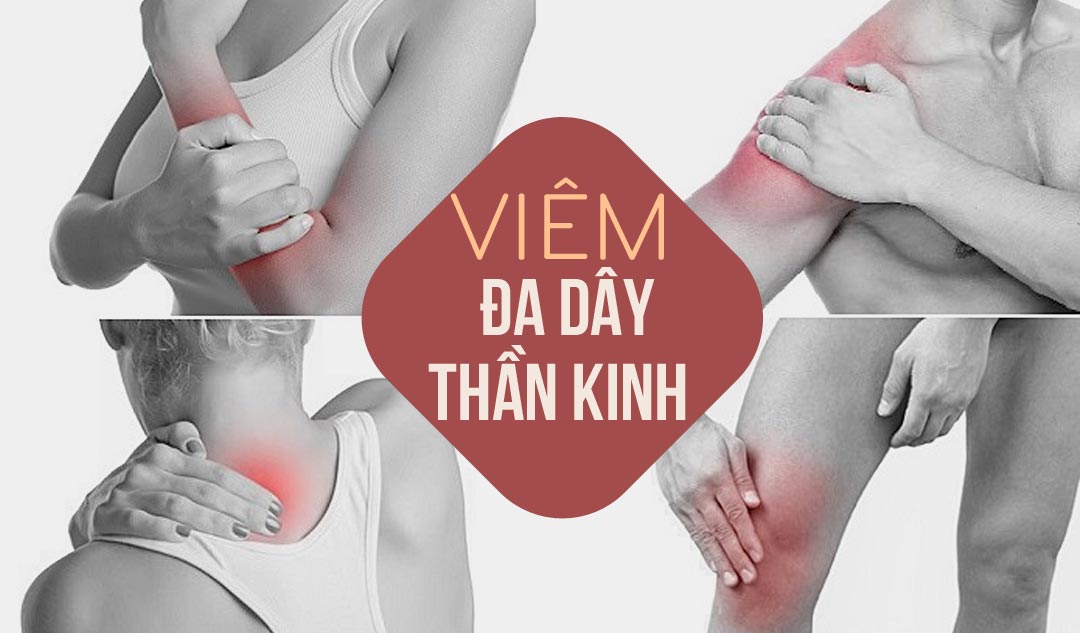 Bệnh Viêm Đa Dây Thần Kinh