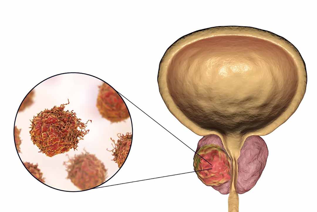 Darolutamide làm chậm sự lây lan của ung thư tuyến tiền liệt