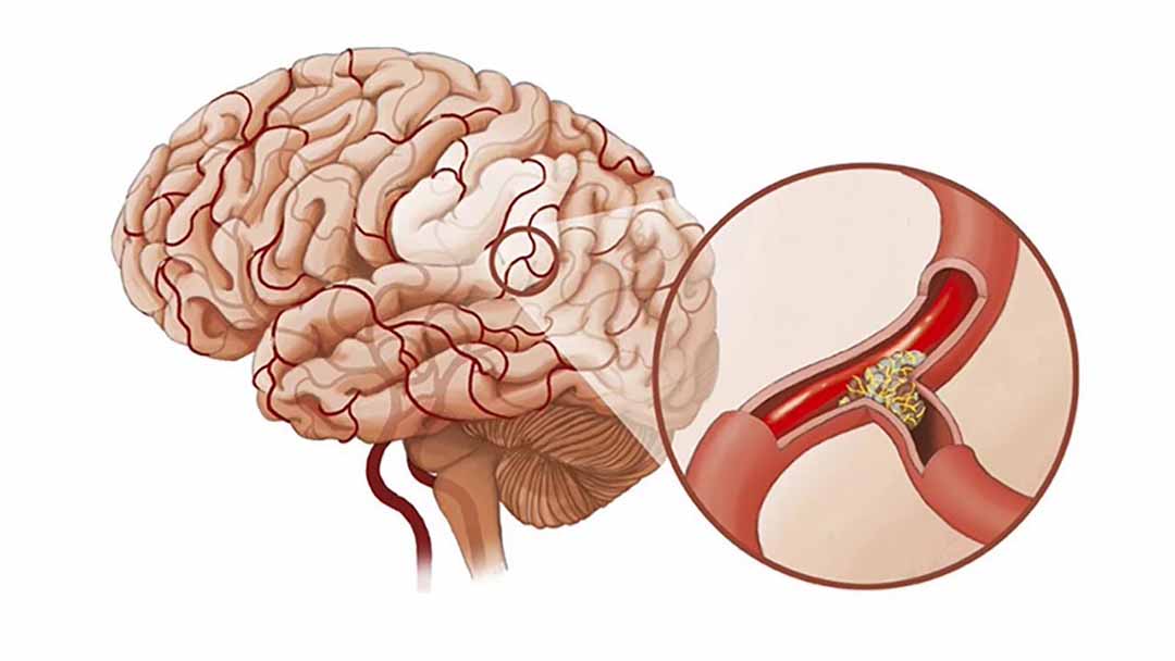 Dấu hiệu nhận biết sớm tai biến mạch máu não và cách xử lý