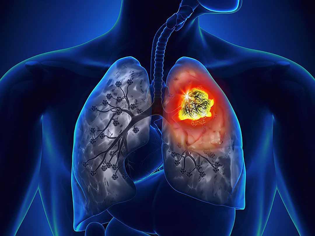 Dấu hiệu những cơn ho chết người cảnh báo ung thư phổi