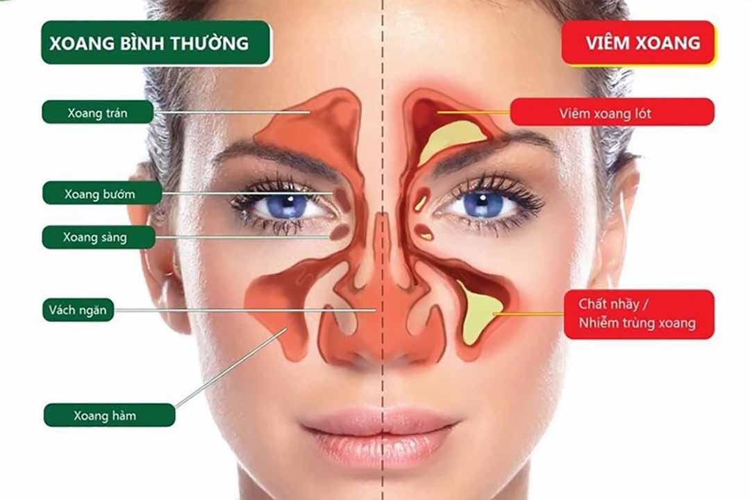 Tổng hợp các bệnh về mũi, xoang mũi và hướng điều trị