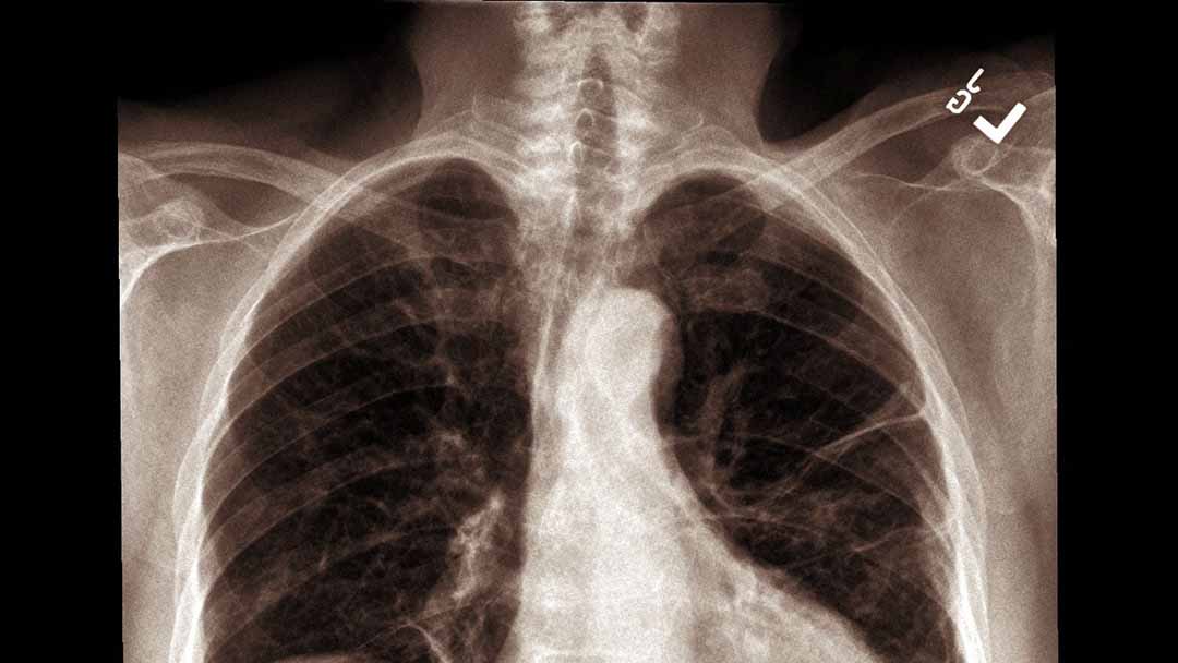 Thử nghiệm ở 122 người được phát hiện có hạch phổi sau khi họ được chụp CT ngực. 