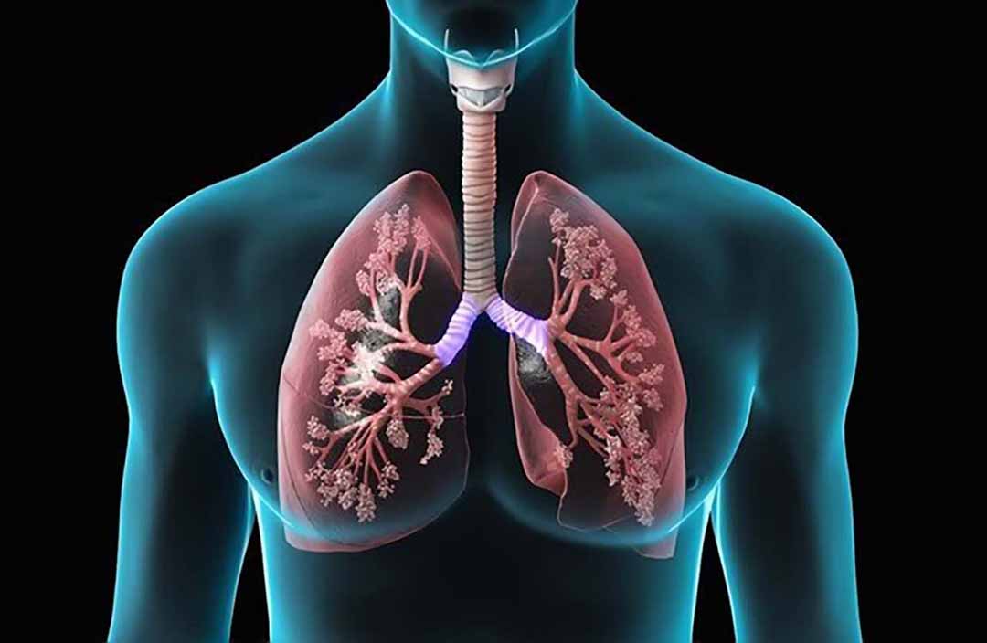 Tổng quan về bệnh lao phổi