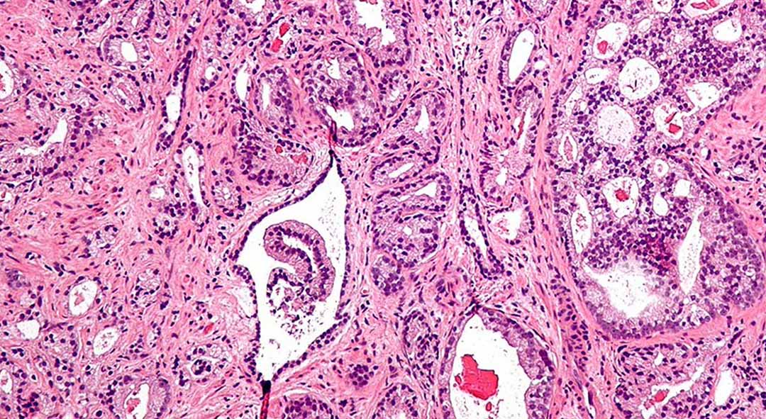 Máy chụp ảnh vi mô cho thấy prostatic acinar adenocarcinoma ( dạng phổ biến nhất của ung thư tuyến tiền liệt )