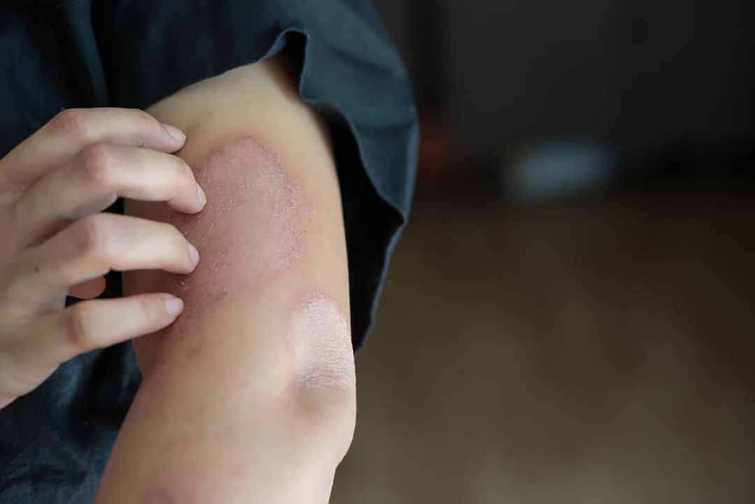 Bệnh Bọng Nước Pemphigoid