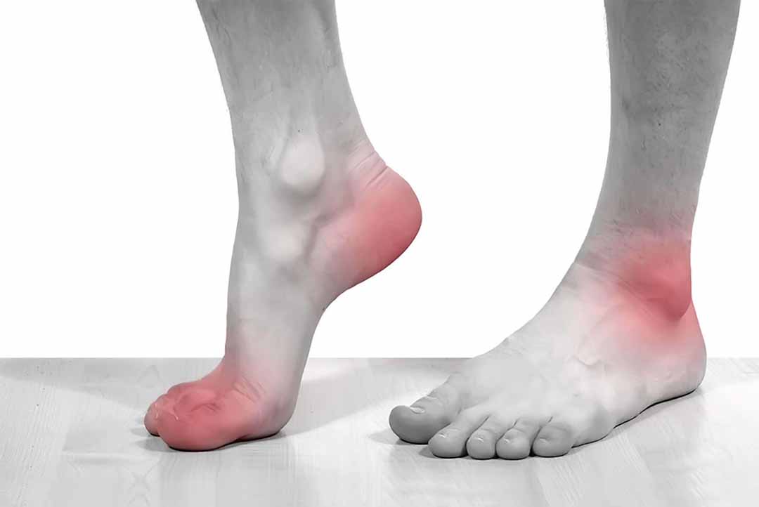 Bệnh giả gout dễ nhầm lẫn với gout