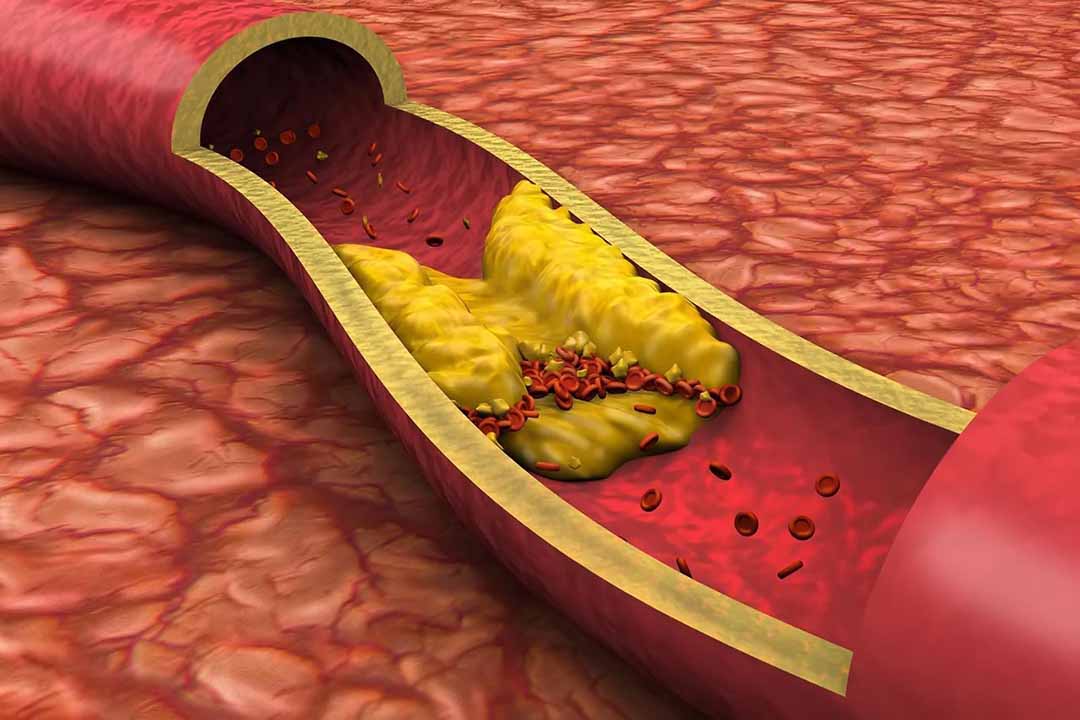 Bệnh LDL Cholesterol