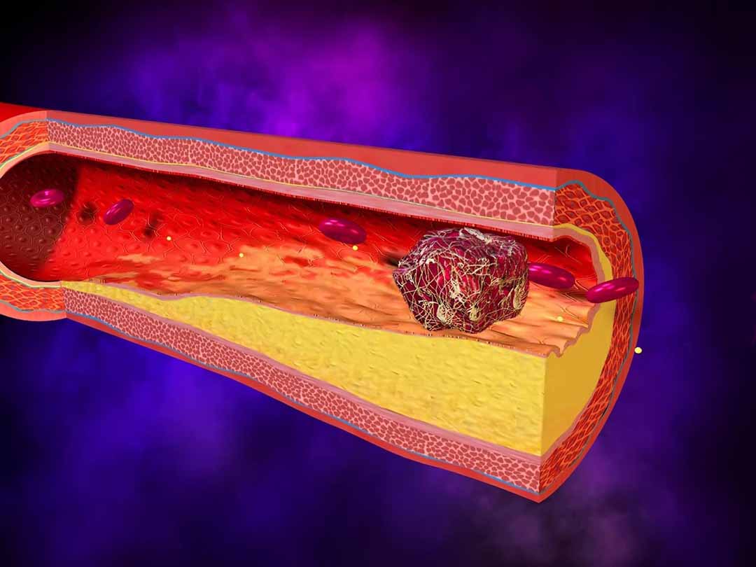 Bệnh Sarcoma Mô Mềm