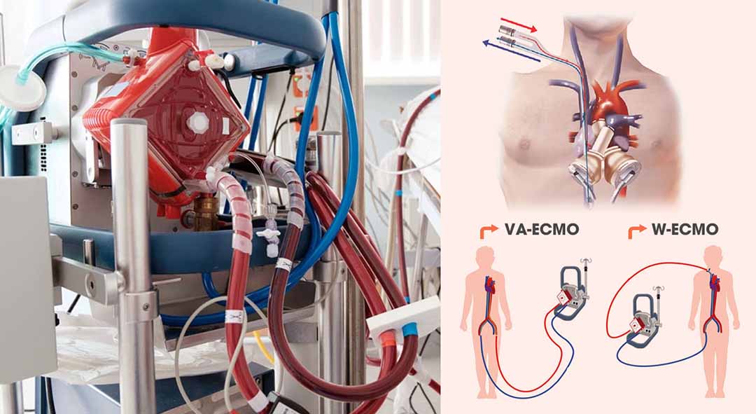 ECMO (tim phổi nhân tạo)