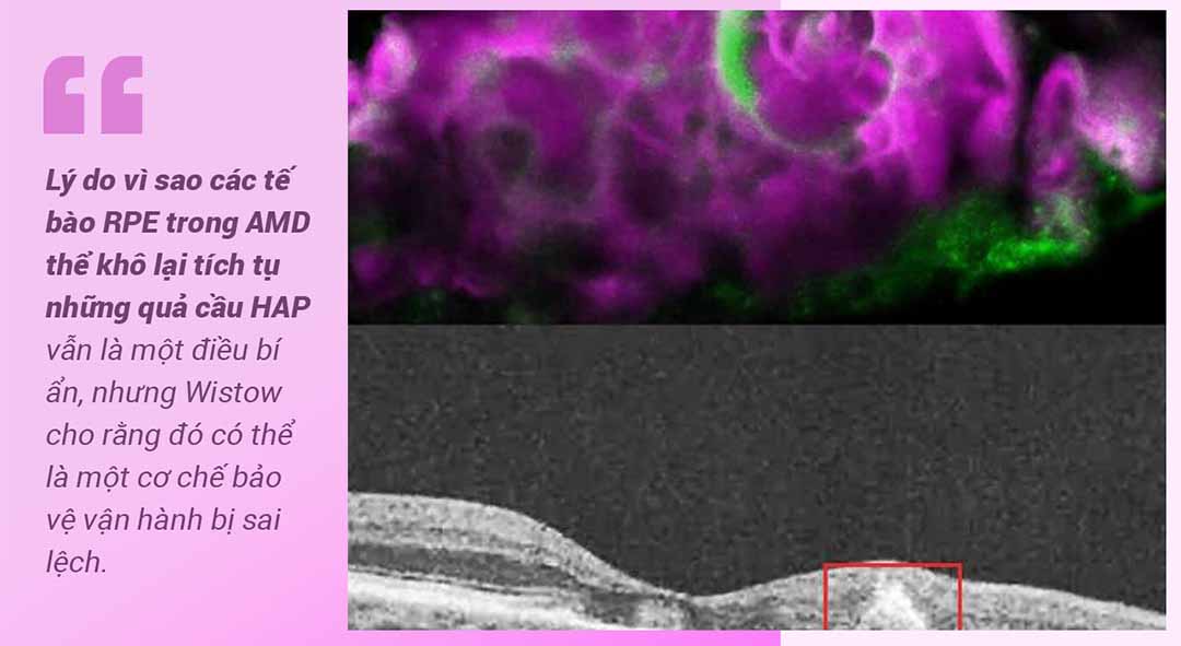 HAP hình cầu (màu hồng) và protein amelotin (màu xanh lá cây) trong drusen mềm ở mắt trên bệnh nhân mắc AMD thể khô. Dưới cùng là : Hình ảnh OCT của mắt bị AMD thể khô, bức ảnh cho thấy hình ảnh drusen mềm ở bên dưới biểu mô sắc tố võng mạc. Thực hiện : Dinusha Rajapakse, Viện mắt quốc gia (NEI).