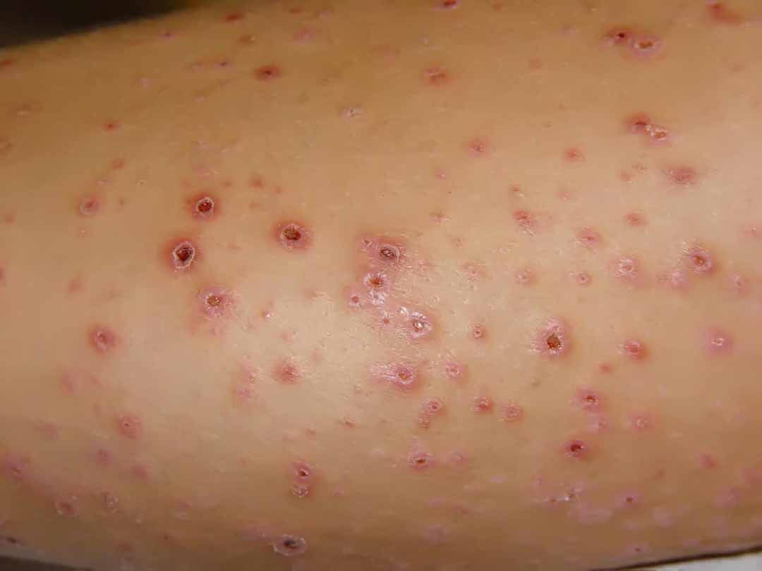 Á vảy nến và vảy phấn dạng LICHEN (Parapsoriasis and Pityriasis Lichenoides)