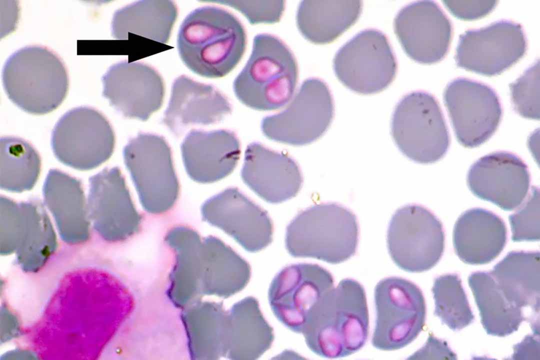 Bệnh Babesia (nhiễm trùng do Babesia)