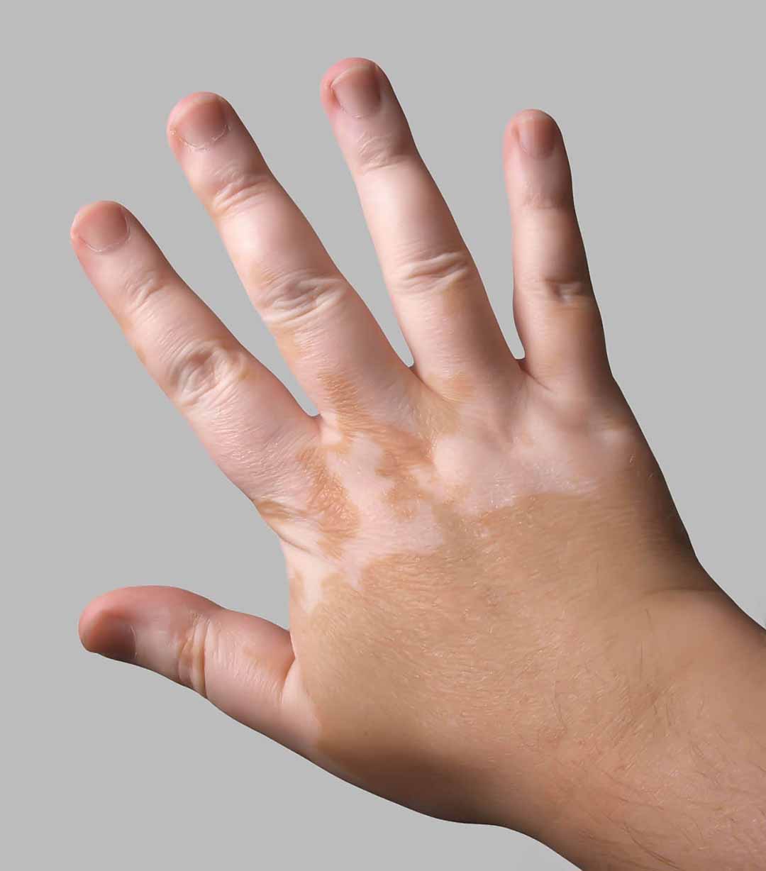 Tổng quan về bệnh bạch biến (Vitiligo)