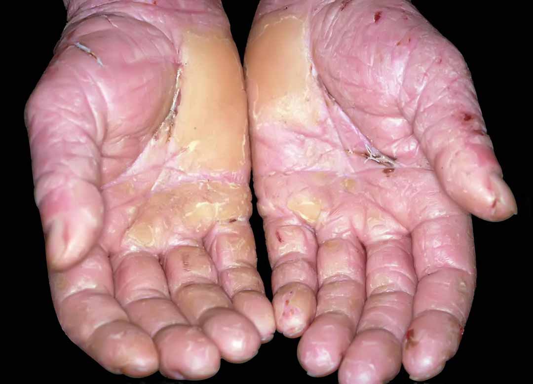 Bệnh da nghề nghiệp (Occupational skin diseases)