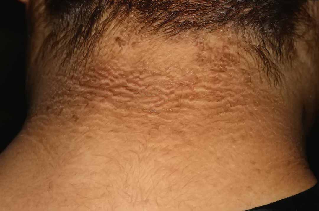 Bệnh gai đen (Acanthosis nigricans)