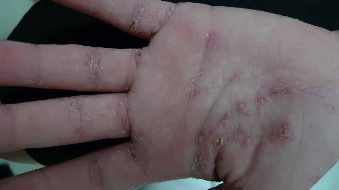 Bệnh ghẻ (Scabies)