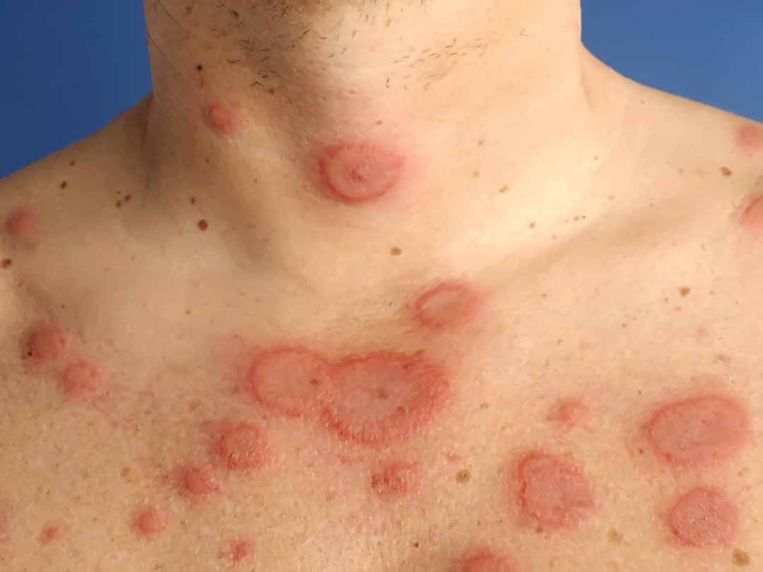 Bệnh lupus ban đỏ (Lupus Erythematosus)