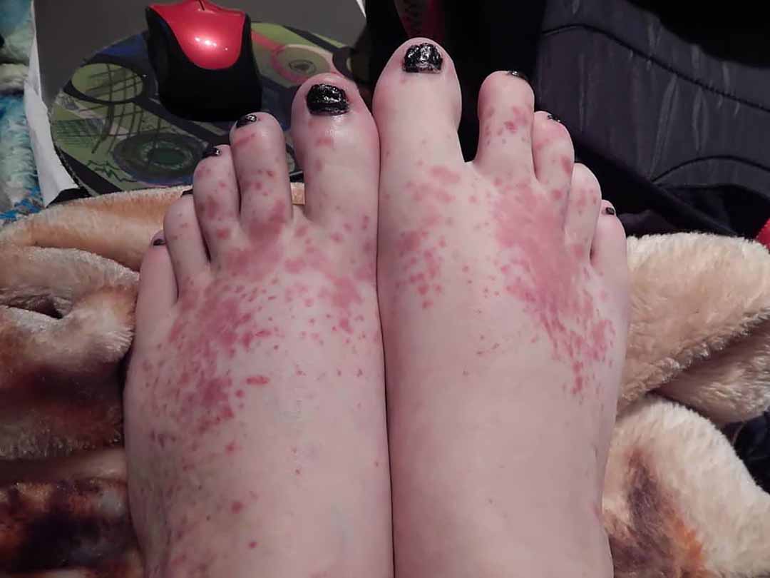 Bệnh mày đay (Urticaria)