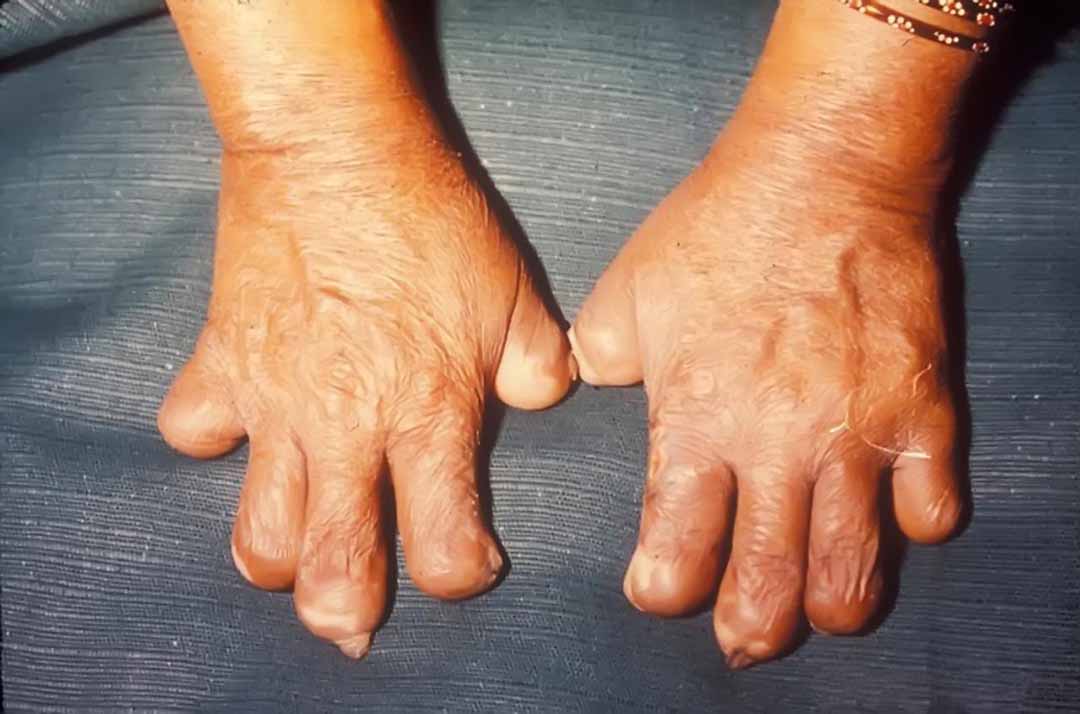 BỆNH PHONG (Leprosy)