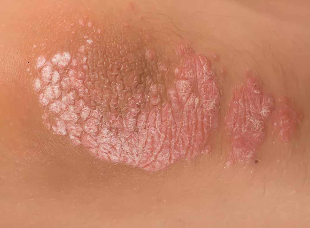 Bệnh vảy nến (Psoriasis)