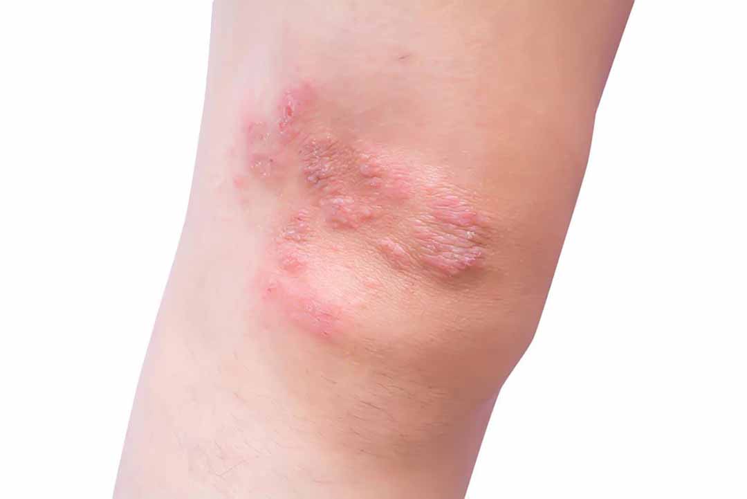 Bệnh viêm da dạng Herpes của DUHRING-BROCQ (Dermatitis Herpetiformis)