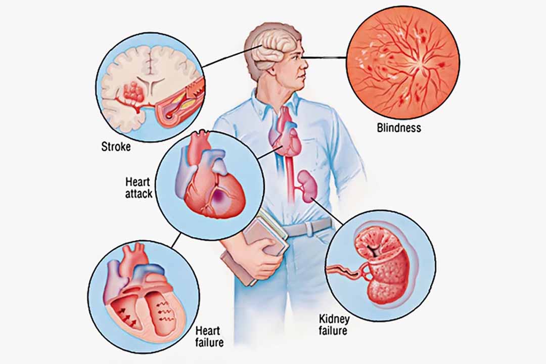 Biến chứng và các thể loại bệnh cao huyết áp