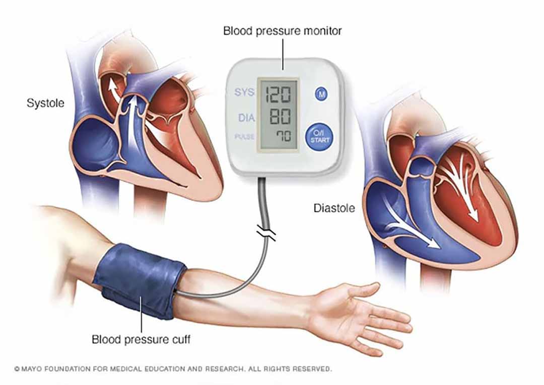 Tổng quan về Huyết Áp và bệnh Cao Huyết Áp