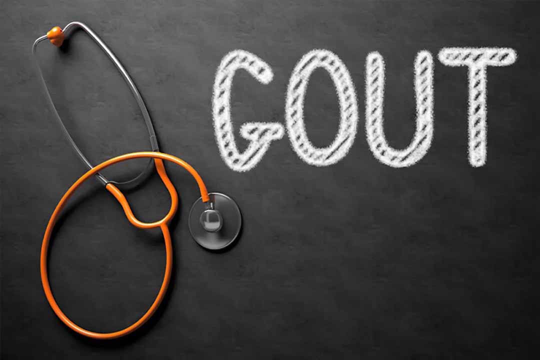 Gout được điều trị ra sao?