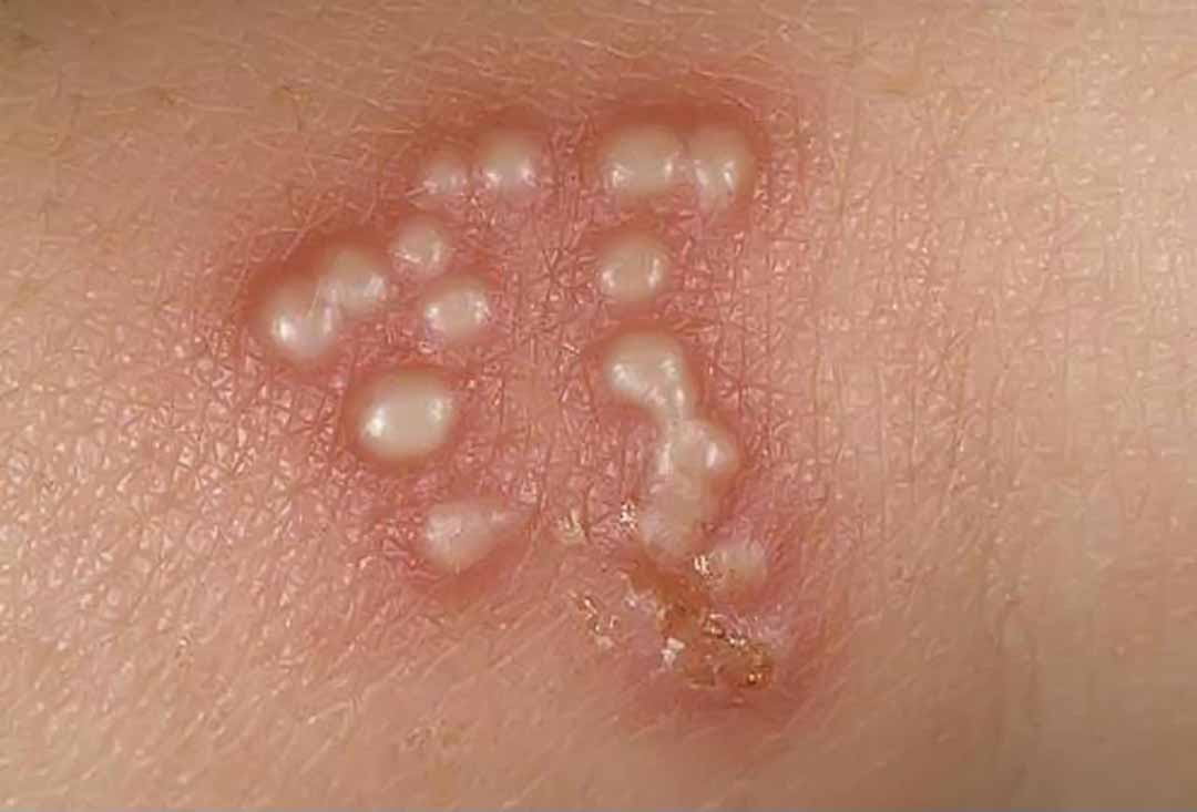 Herpes sinh dục (Genital herpes simplex viral infections)