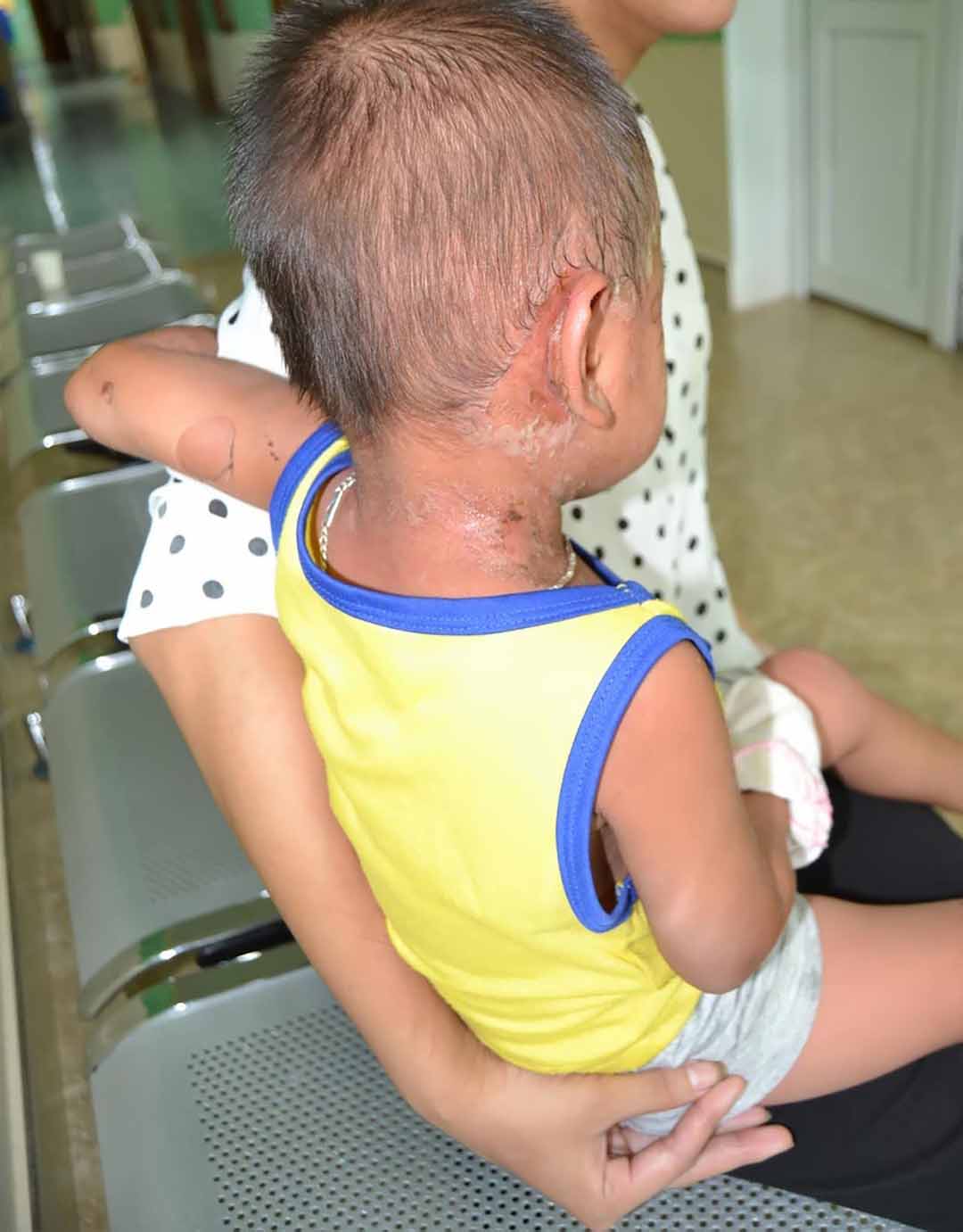 Hội chứng bong vảy da do tụ cầu (Staphylococcal Scalded Skin Syndrome - SSSS)