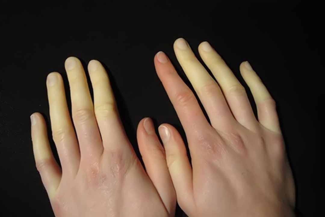 Hội chứng RAYNAUD