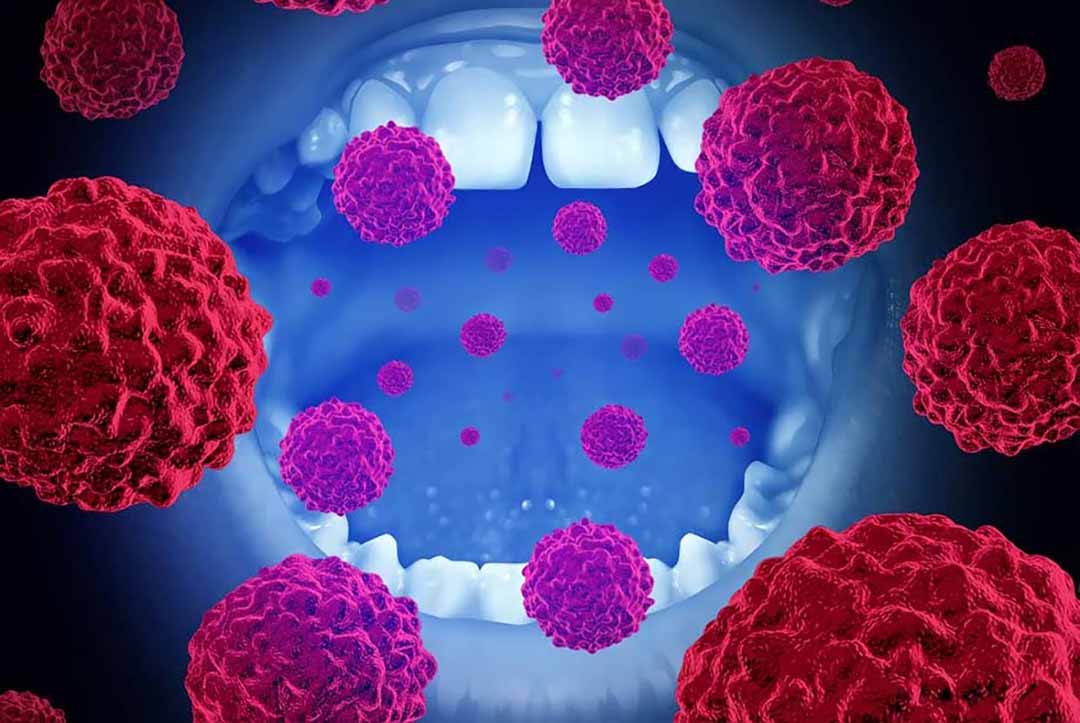 HPV và Ung thư miệng