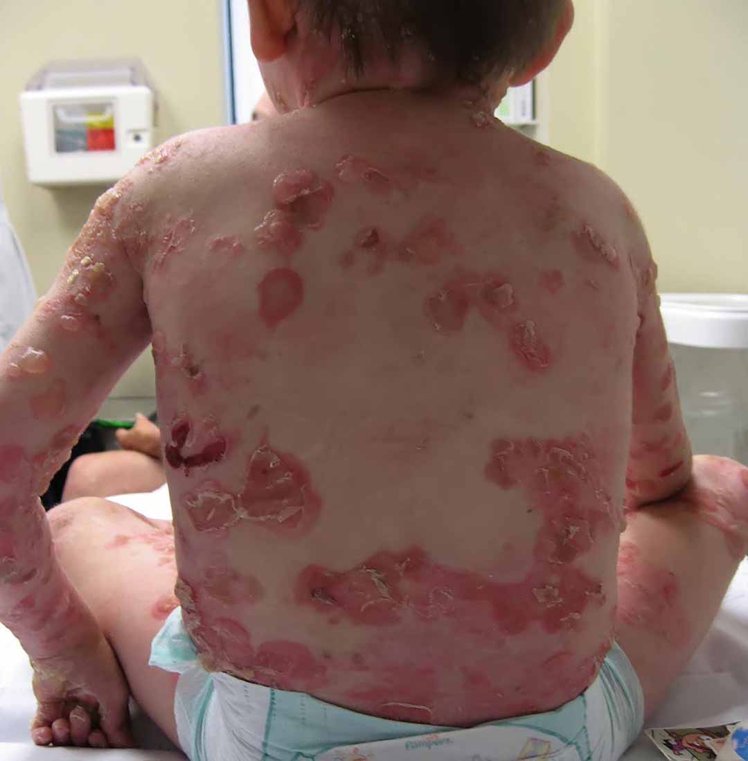 Ly thượng bì bọng nước bẩm sinh (Inherited epidermolysis bullosa)